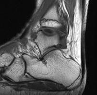 Talus OCD Anterolateral MRI0001